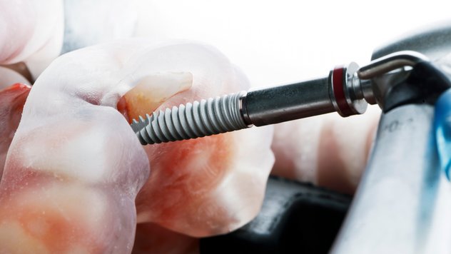 Zahn Implantate in Rheinfelden